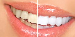 West LA Dental Care Heigiene