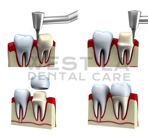 West LA Dental Care Heigiene