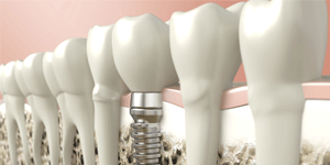 West LA Dental Care Heigiene