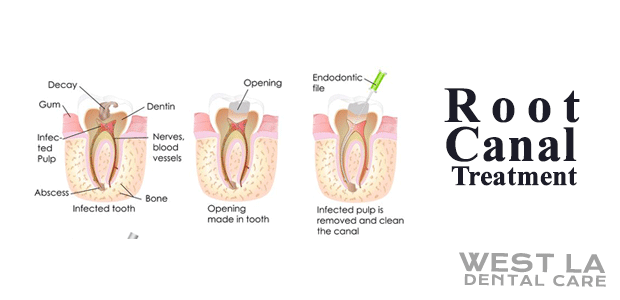 West LA Dental Care Oral Hygeine